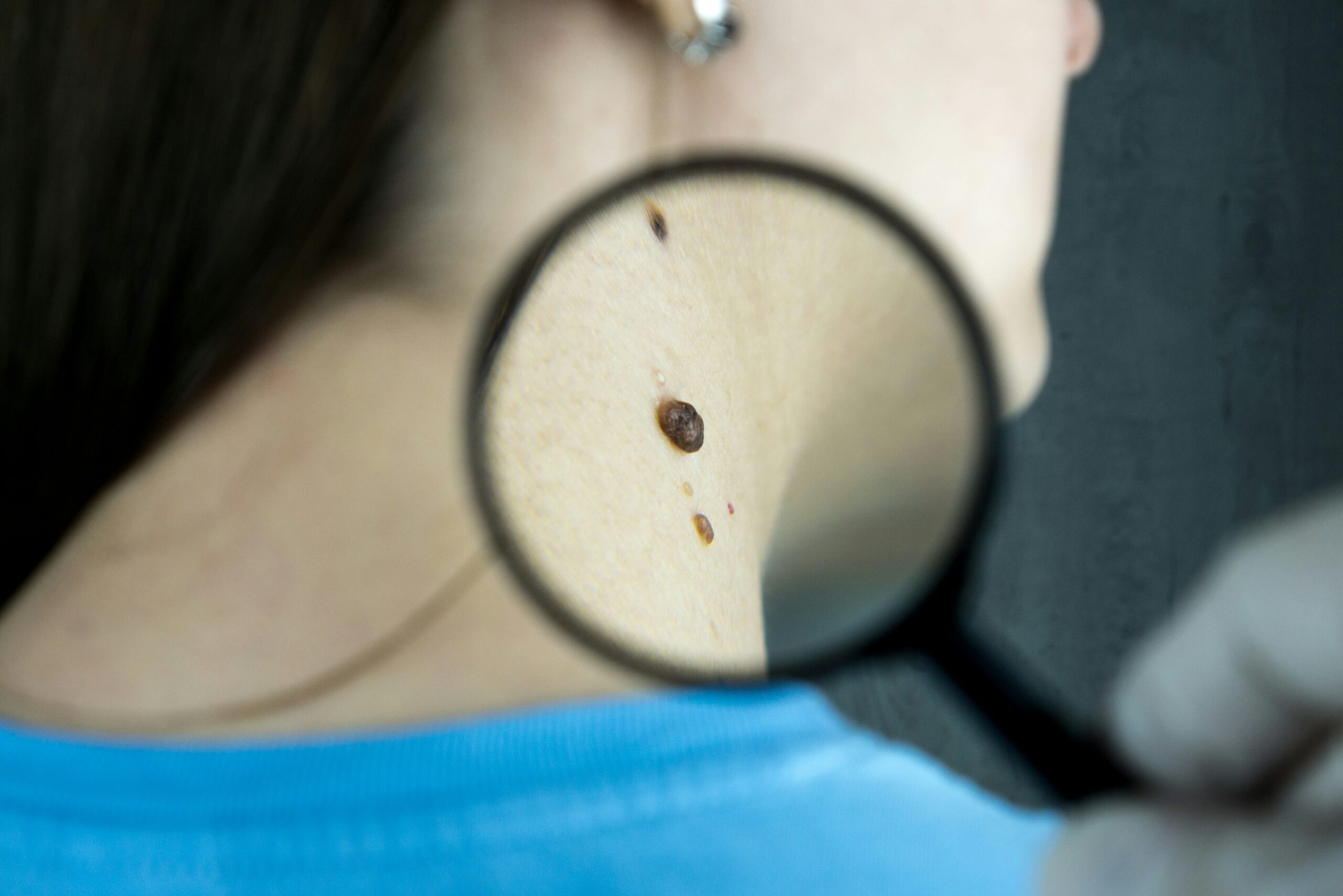 Nodular Melanoma: Symptoms, Causes, Diagnosis, Treatment, and Early Warning Signs