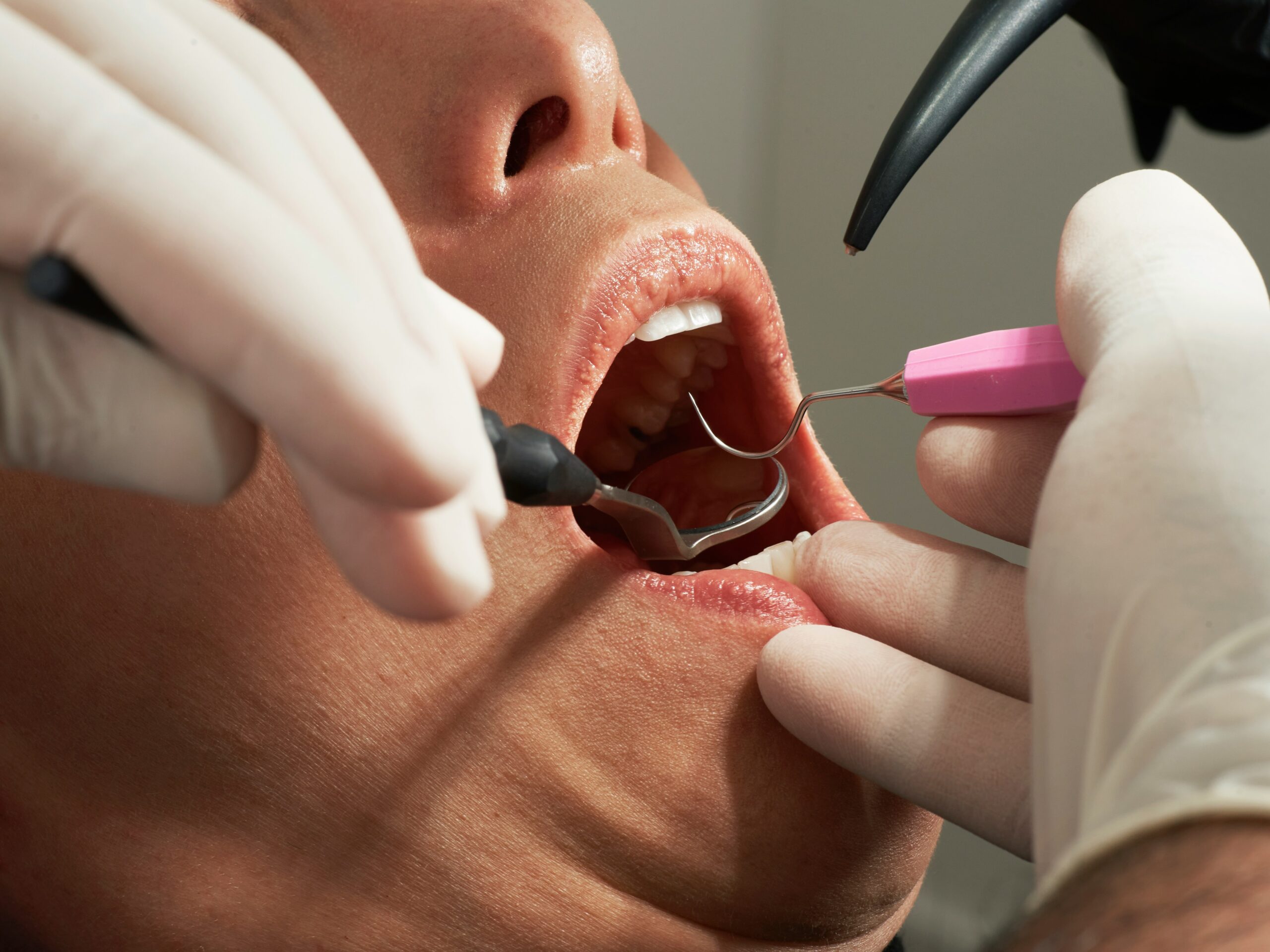 Mandibular Tori: The Ultimate Guide to Causes, Symptoms, Diagnosis, and Treatment