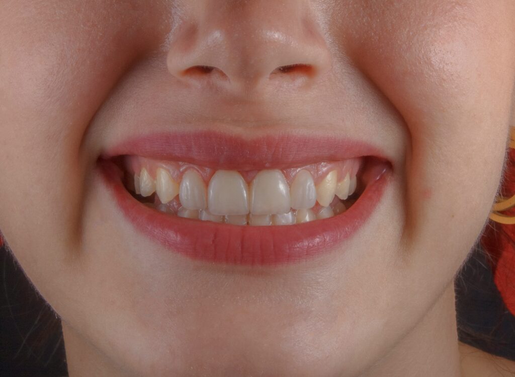 Gone Wrong Buccal Fat Removal Smile featuring facial changes, cosmetic surgery risks, recovery, side effects, and corrective treatment options.