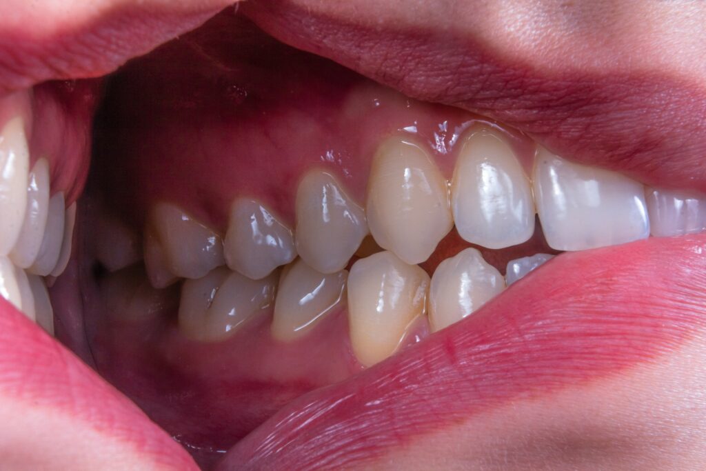 Mandibular Tori guide to causes, diagnosis, treatment, oral hygiene, recovery, and preventive dental care.