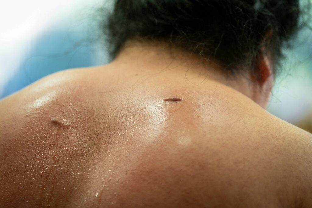 Nodular Melanoma guide to causes, risk factors, warning signs, treatment, recovery, and skin health.