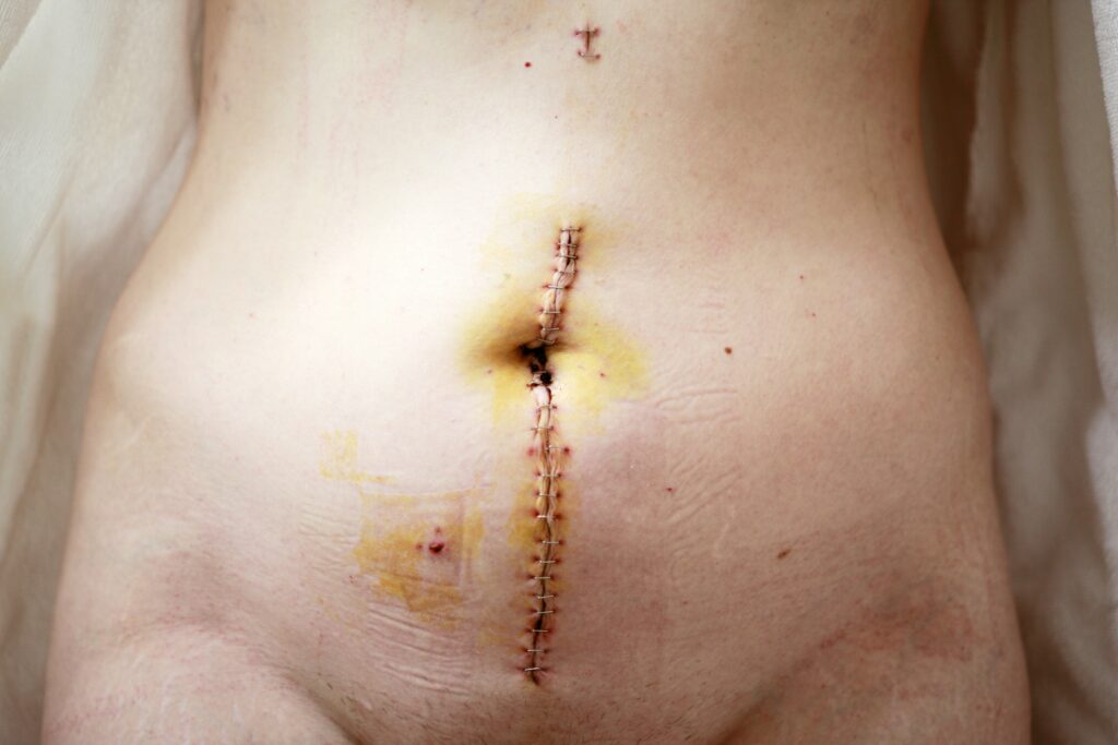 Uterine ablation side effects years later: Exploring long-term changes and possible symptoms.