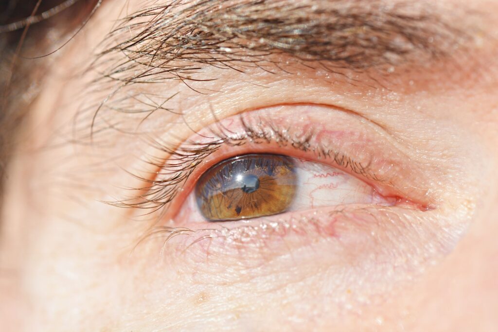 Will hardened chalazion go away with time and proper care
