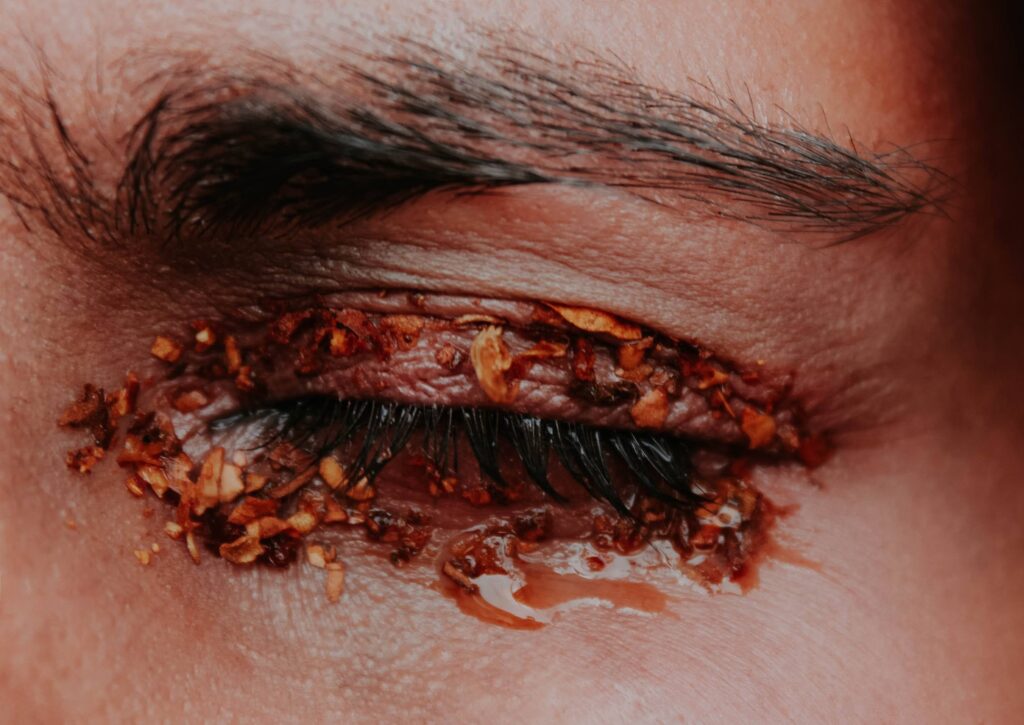 Will hardened chalazion go away and when to seek treatment